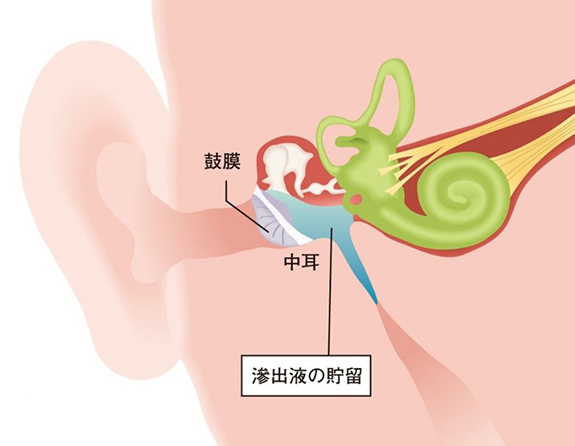 こどもの聞こえが悪い、大声でしゃべることが多いです。どうしてですか？？